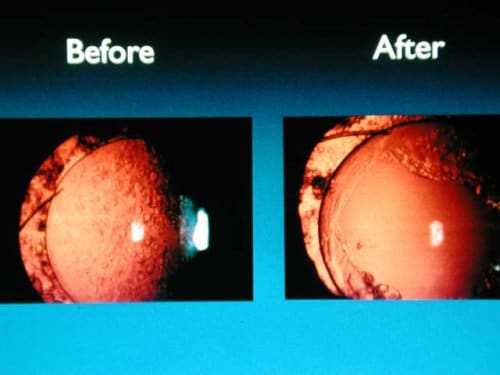 cataract surgery before eye cataracts bag come lens astigmatism without implant glasses distance zephyrhills clinic florida often