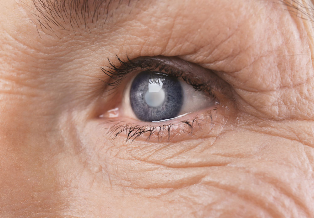 Three Warning Signs of Cataracts
