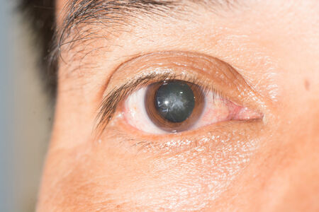 What To Expect from Cataract Surgery Before, During, and Afterward