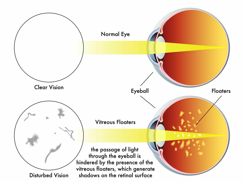Read more about the article When To Be Concerned with Eye Floaters
