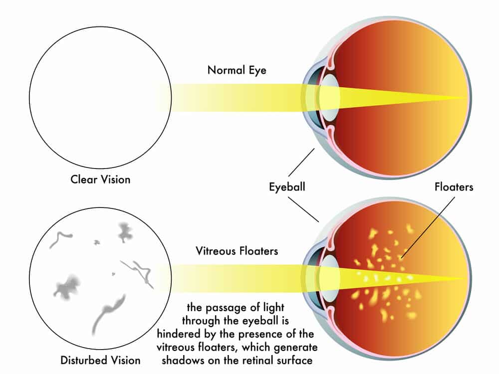 Clear Floaters In Vision