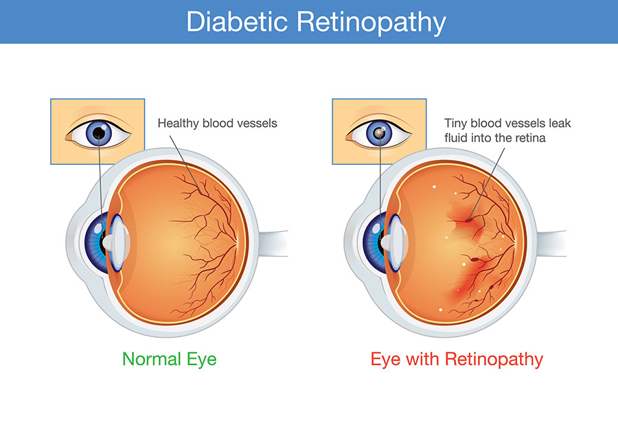 Read more about the article What You Should Know About Diabetic Retinopathy