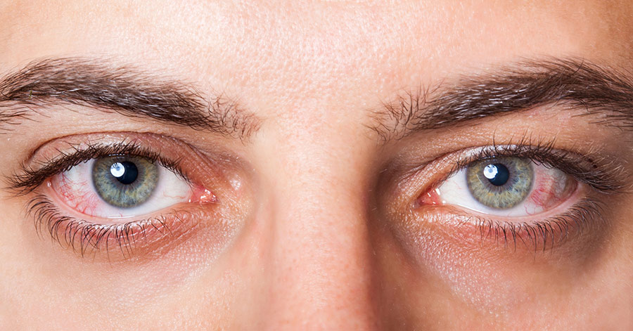 Read more about the article Eye Allergies: Triggers, Symptoms, and Treatments
