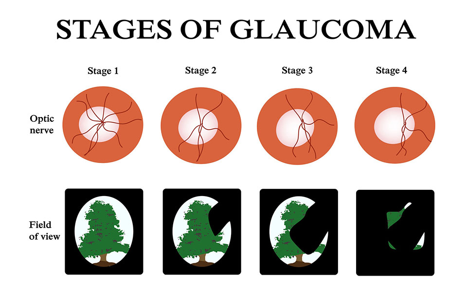 Important Facts About Glaucoma That You Need To Know