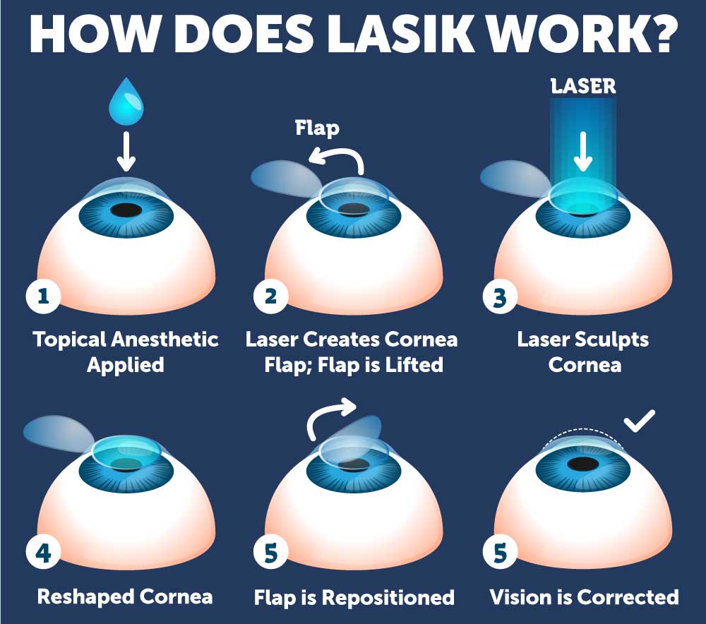 Navigating LASIK Recovery for Clear Vision