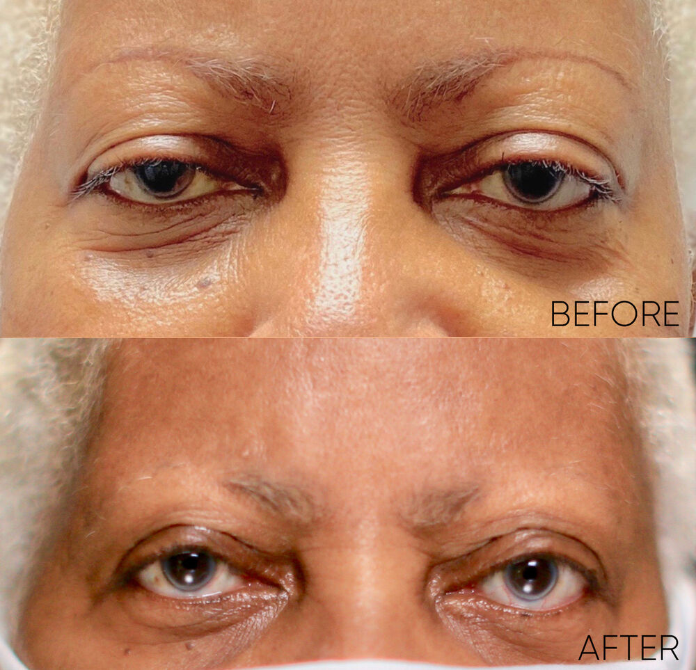 Ptosis Repair Eye Clinic Of Florida 