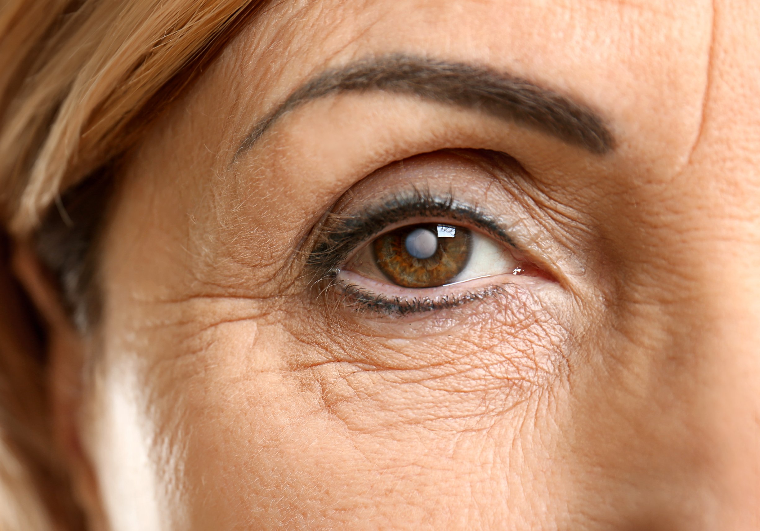 5 Surprising Facts About Cataracts