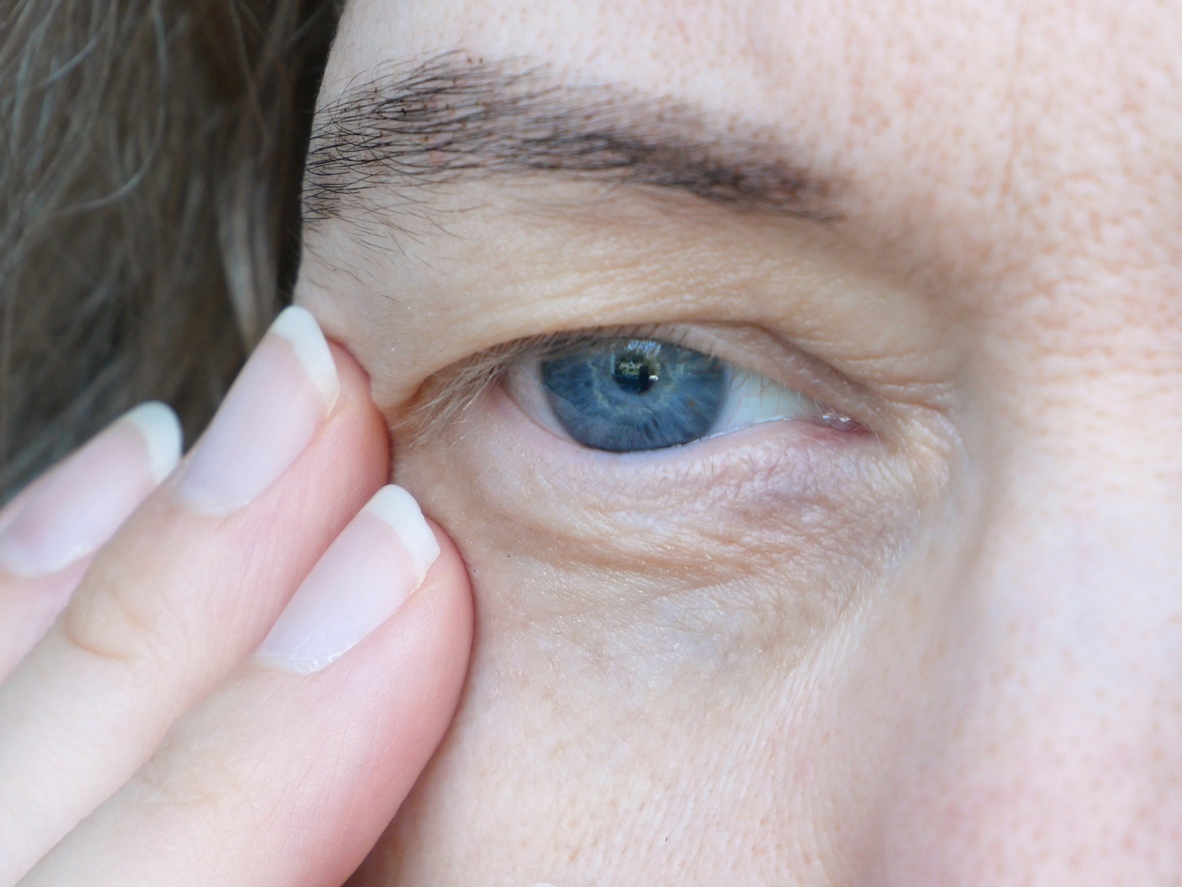What Impact Can Droopy Eyelids Have on Vision?