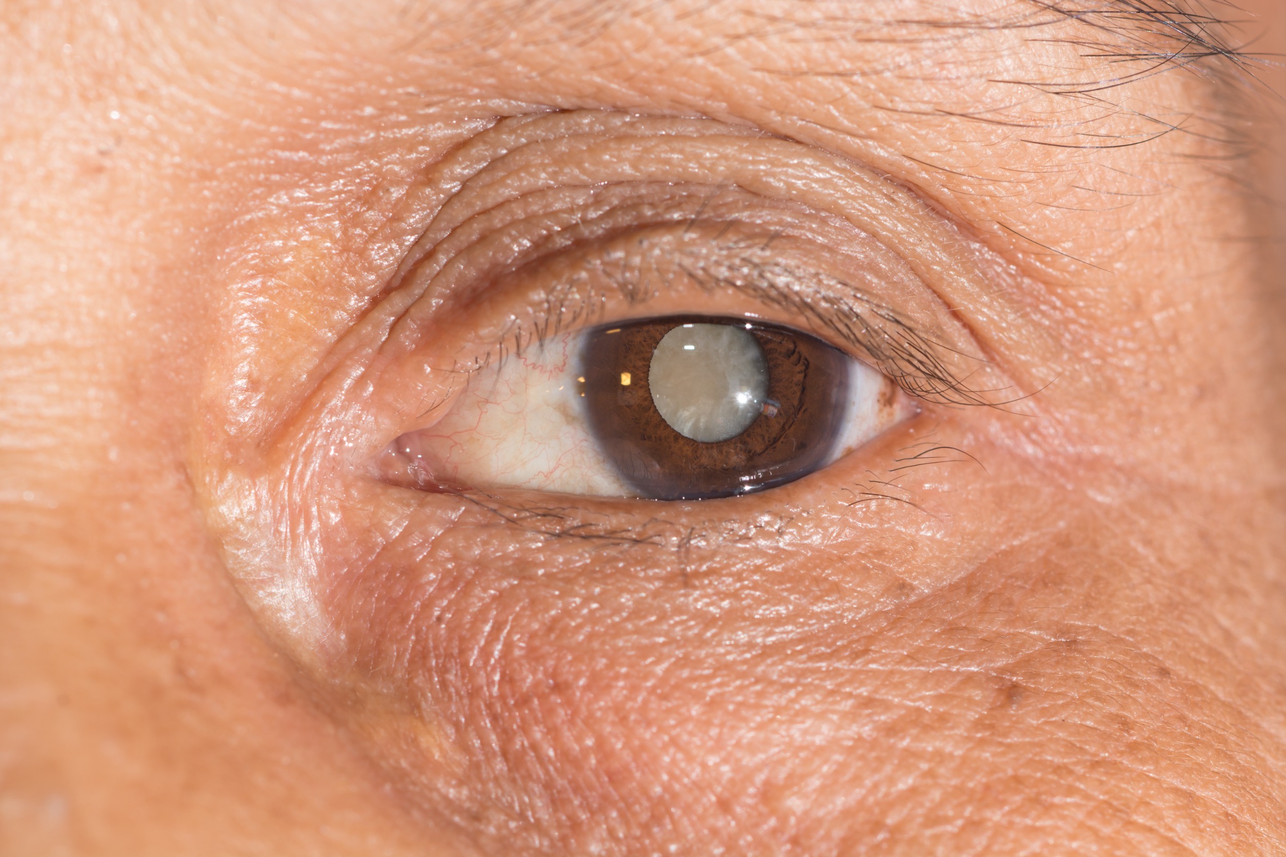 Tips to Lower Your Risk of Cataracts