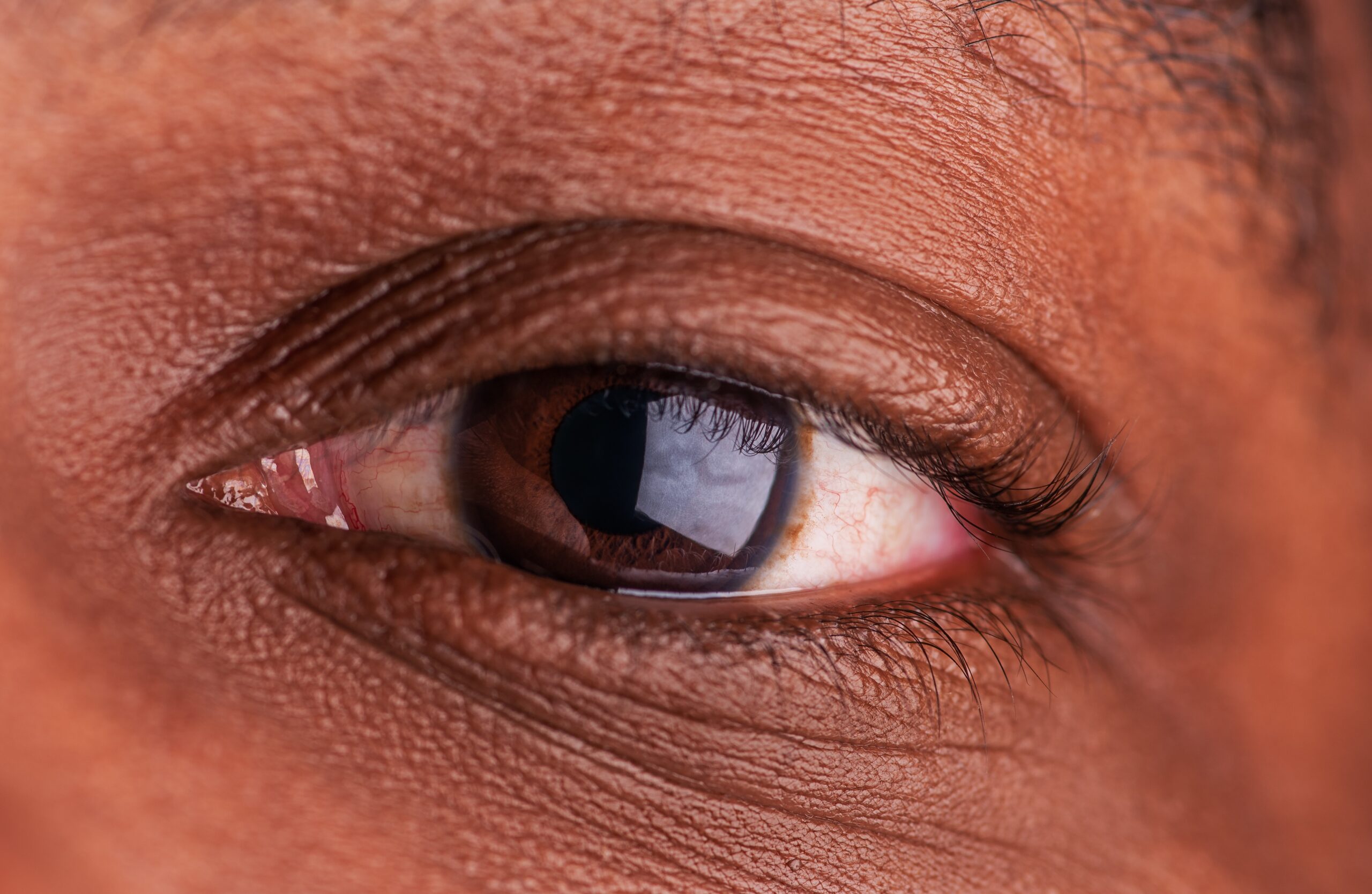 Read more about the article Understanding the Different Types of Glaucoma
